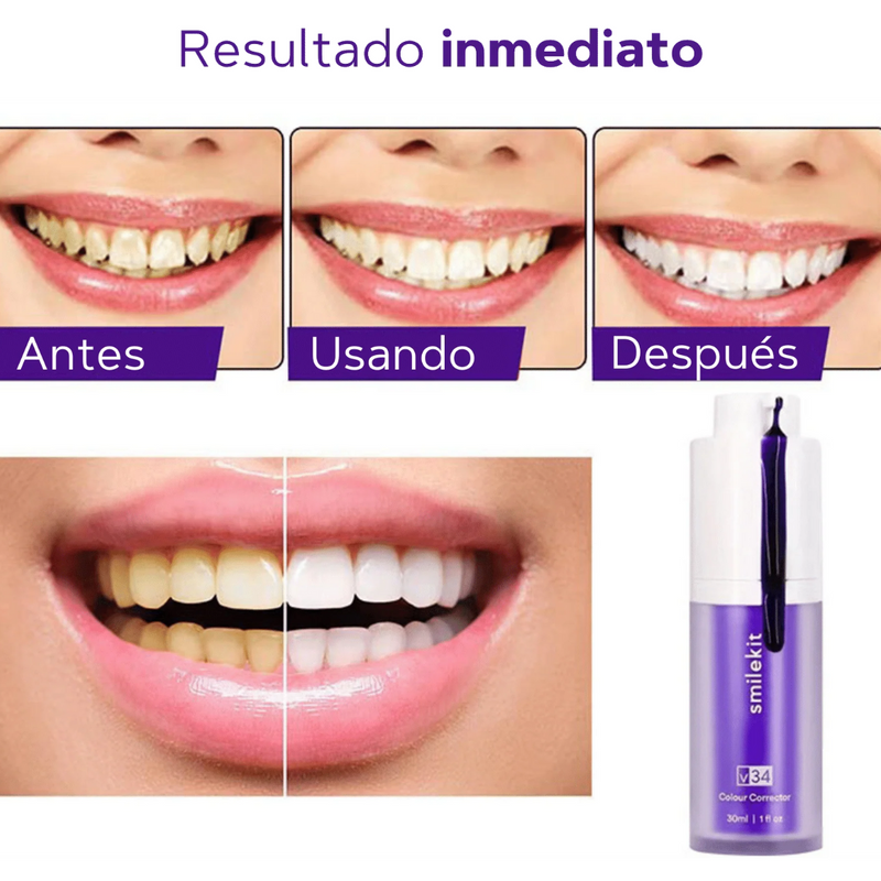 SmileKit - Blanqueador Dental - Sonrisa Radiante Sin Salir de Casa!
