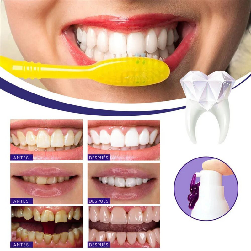 SmileKit - Blanqueador Dental - Sonrisa Radiante Sin Salir de Casa!